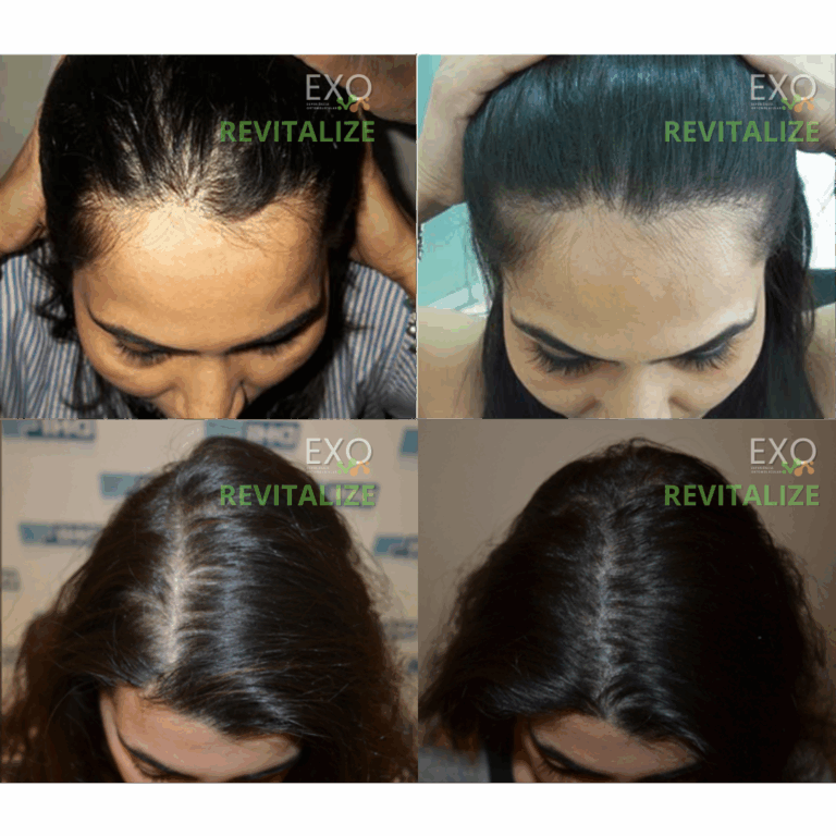 Cabelo Ralo