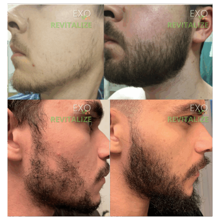 Barba Rala e com falhas